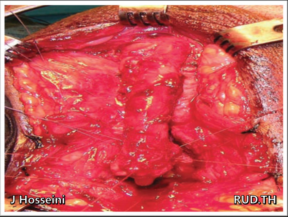 Posterior Urethroplasty Step By  Step