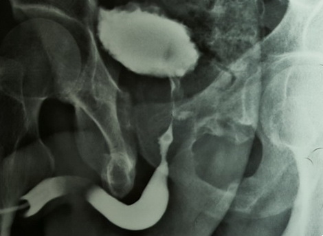 Urethral stricture / defect 